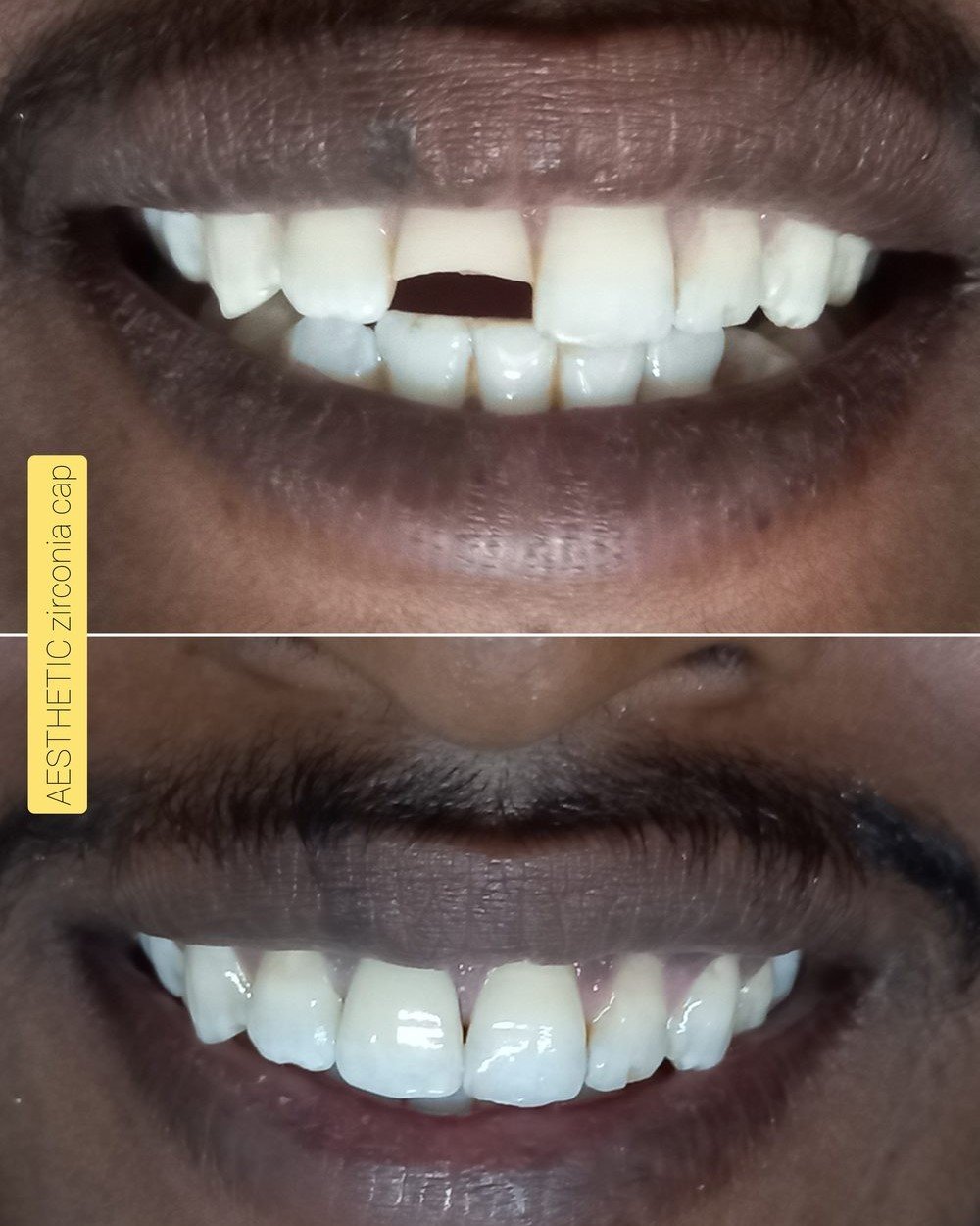 Zirconia cap case