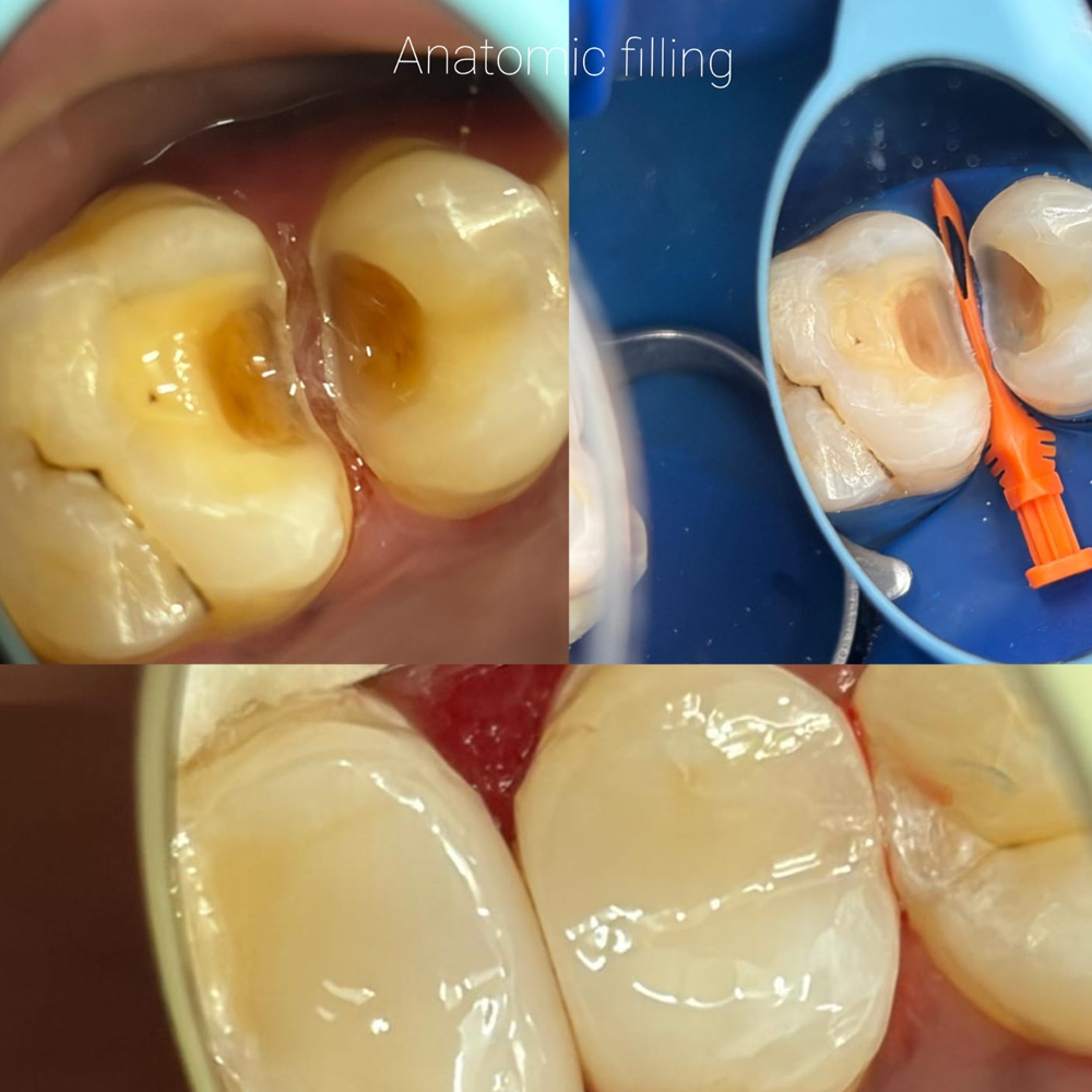 Anatomic Filling