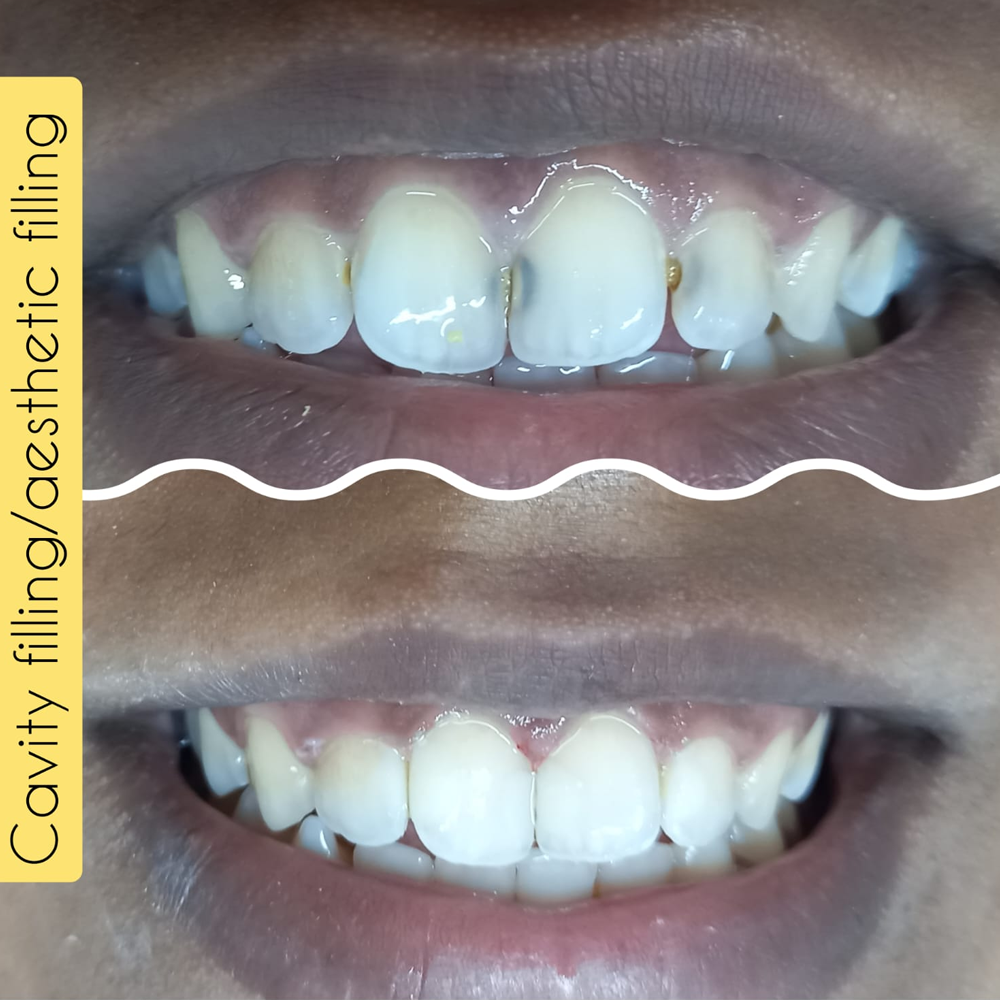 Cavity Filling / Aesthetic Filling