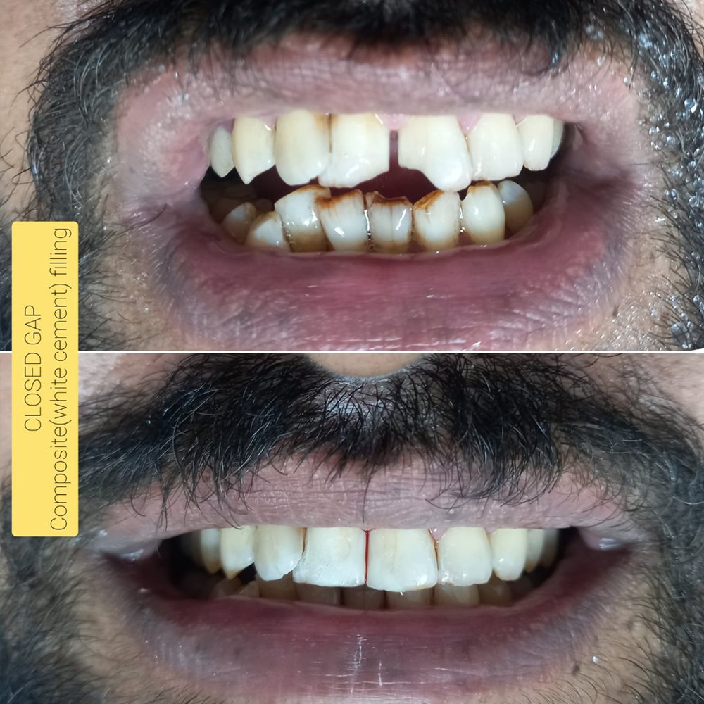 Close Gap with Composite (White Cement) Filling