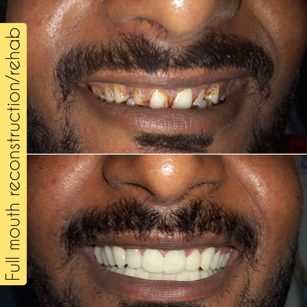 Full Mouth Reconstruction