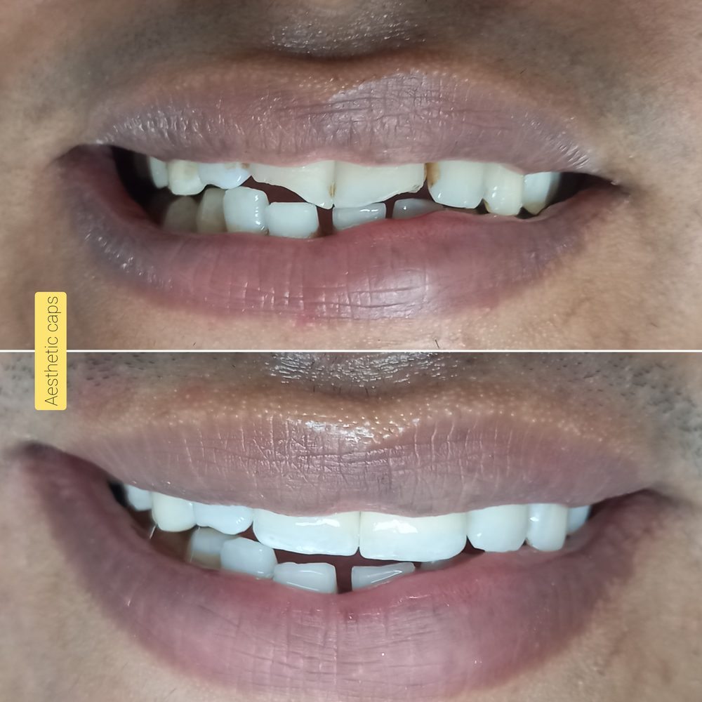 Before and after aesthetic dental caps on front teeth