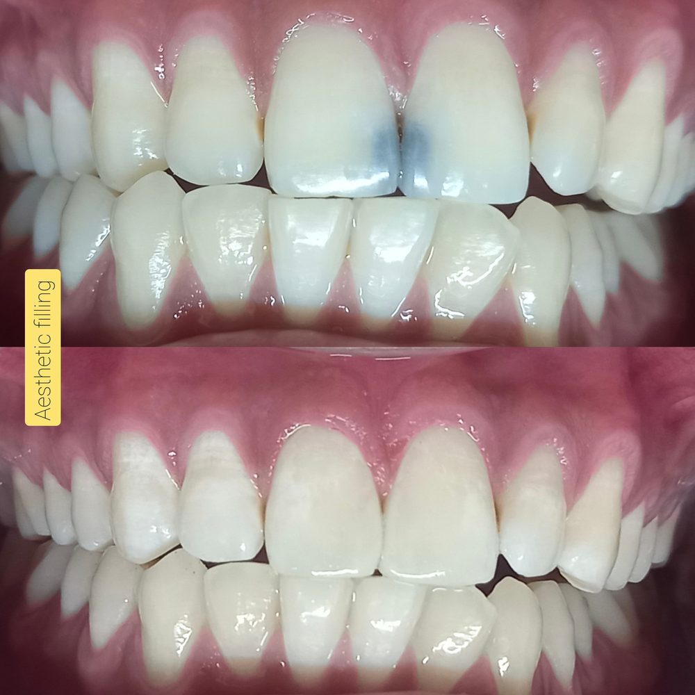 Before and after aesthetic filling covering a discoloured front tooth