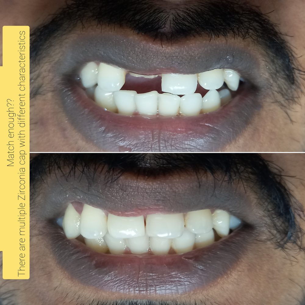 Before and after multiple zirconia caps matched to natural tooth shade