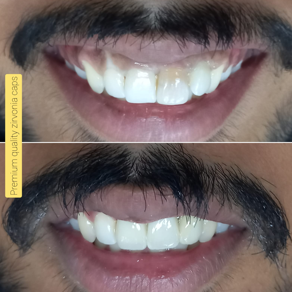 Premium Quality Zirconia Cap
