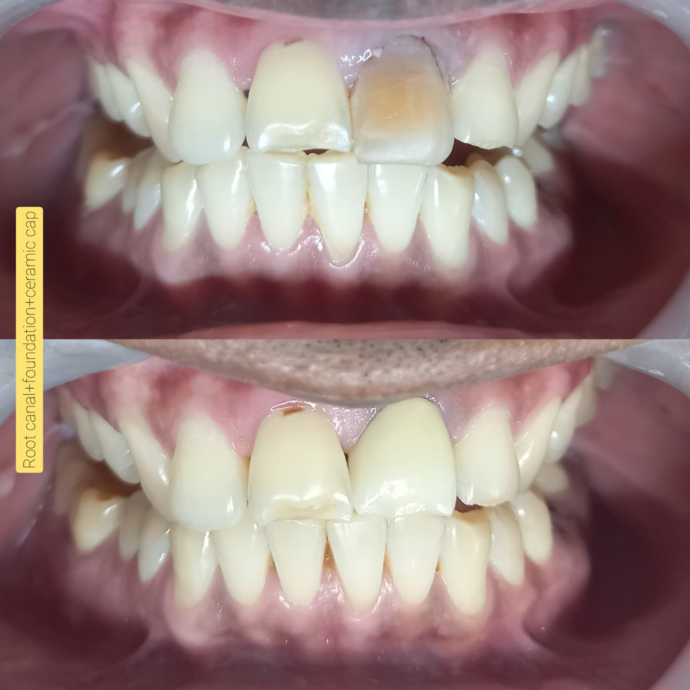 Root Canal + Foundation + Ceramic Cap