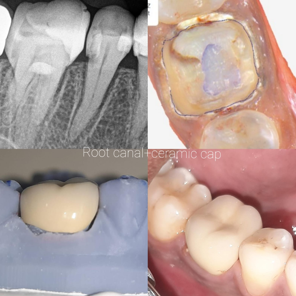 Root Canal Treatment + Ceramic Cap