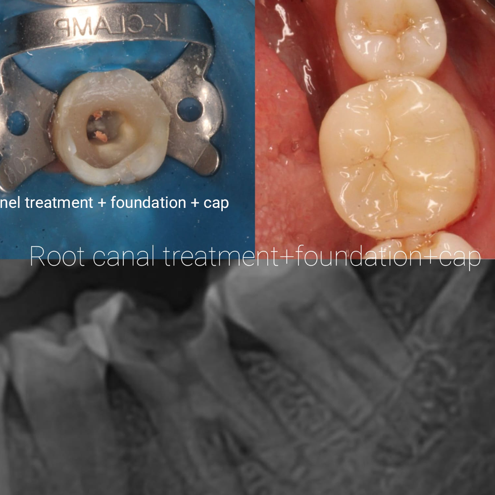 Root Canal Treatment + Foundation + Cap