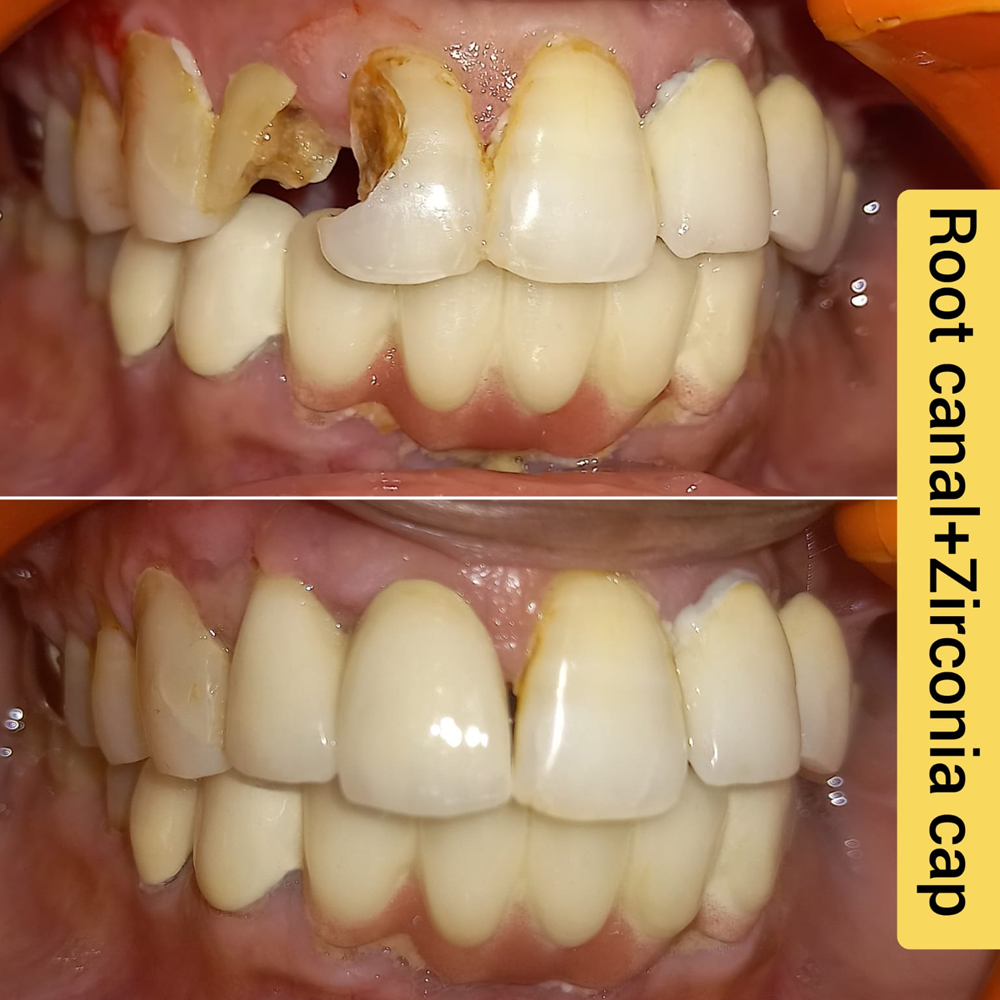 Root Canal Treatment