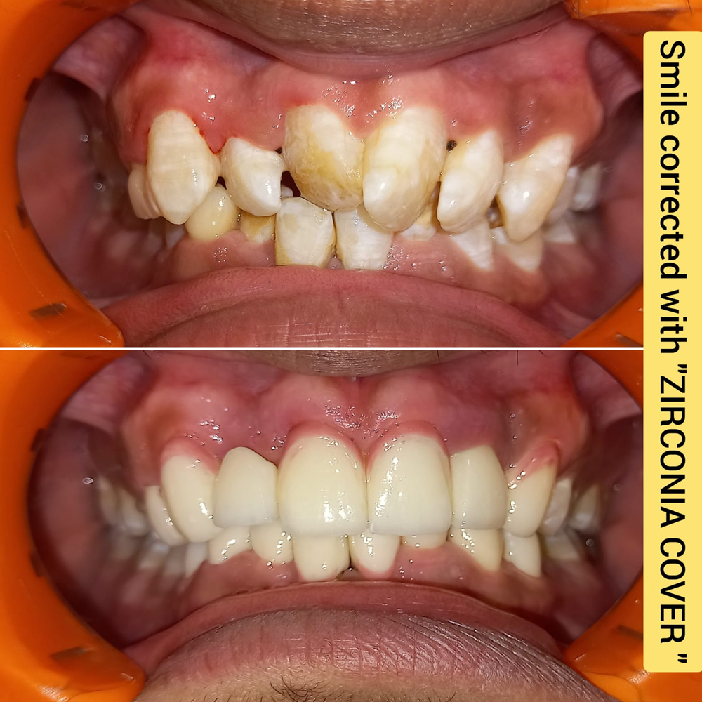 Smile Corrected with Zirconia Crowns