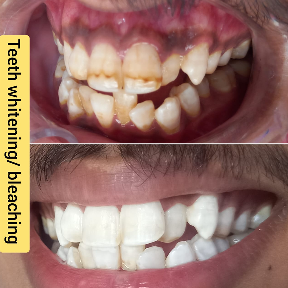 Teeth Whitening / Bleaching