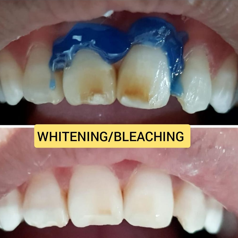 Whitening / Bleaching
