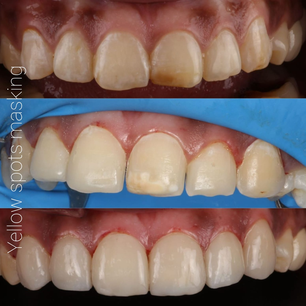 Yellow Spots Masking