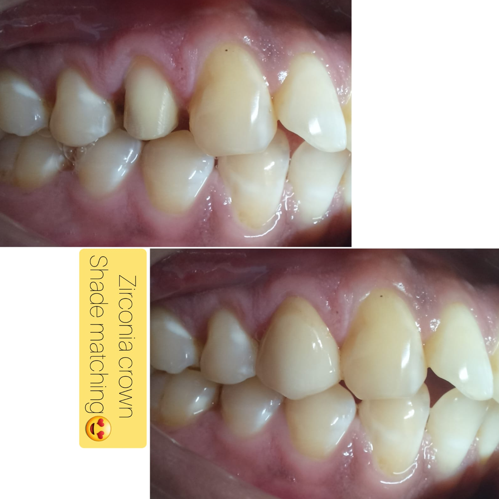 Zirconia Crown