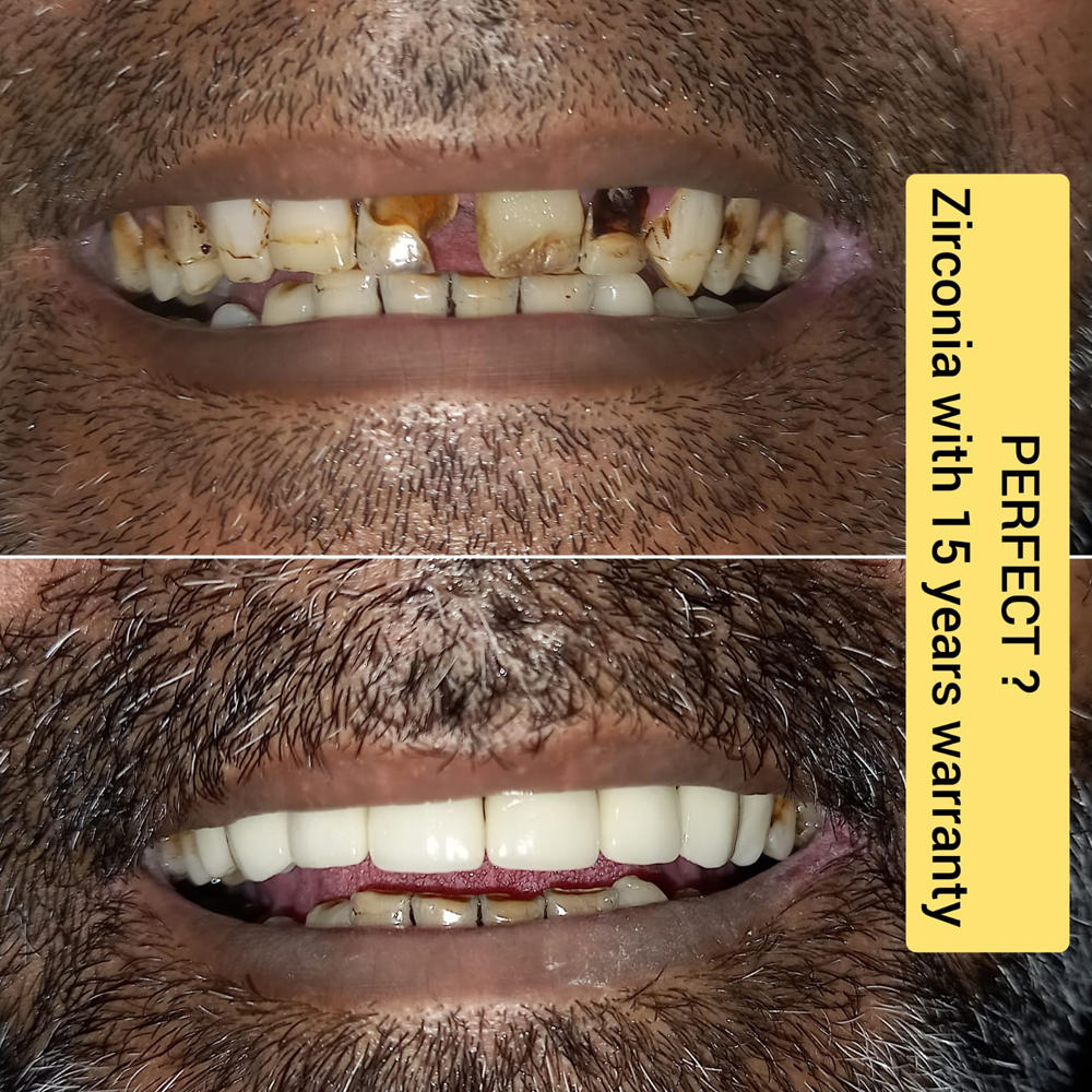 Zirconia with 15-Year Warranty